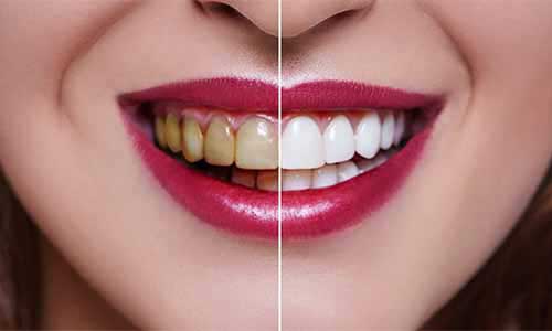 Professional Teeth Whitening in Buford